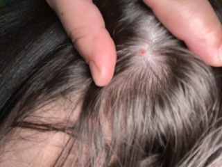 Any ideas what this is on scalp?