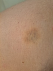 Bruising - Anyone else? Advice?