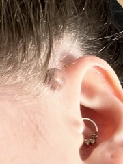 Dark lump on my ear