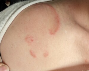 What is this rash?