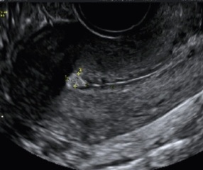 Sudden uterine polyp