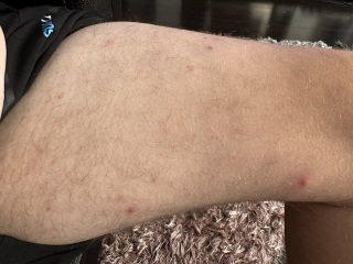What’s these painful spots on my partners legs?