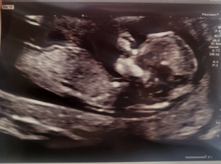 13 weeks Gender??