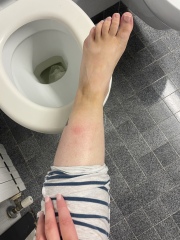 Insect bite when 29 weeks pregnant on holidays in Italy, from UK