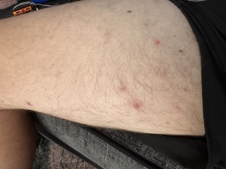 What’s these painful spots on my partners legs?