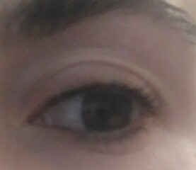 Sagging eyelids in early 30s