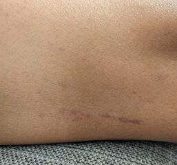 Purpura rash on thighs - with pictures