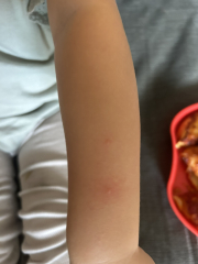 Spots on 2yo’s arm and legs