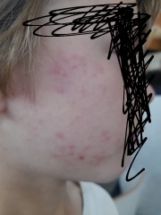 Rash on child's face - please help!