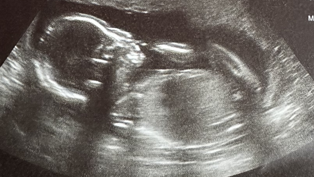 Ivf pregnancy - first trimester