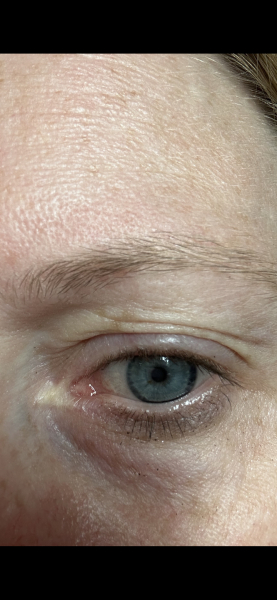 Wrinkles wrinkles wrinkles at 39 help!