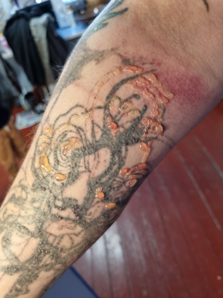 Have you had tattoo 'removal' and how were the results?
