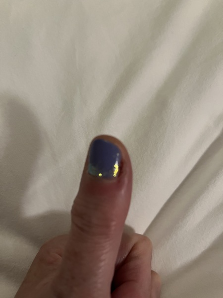 Is my thumb infected? Gross pic