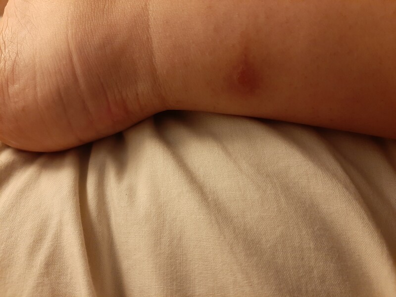 To ask if I should go to A&E or call 111? Pics included