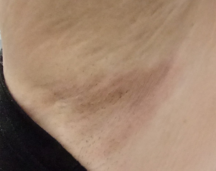 Armpit discoloured.