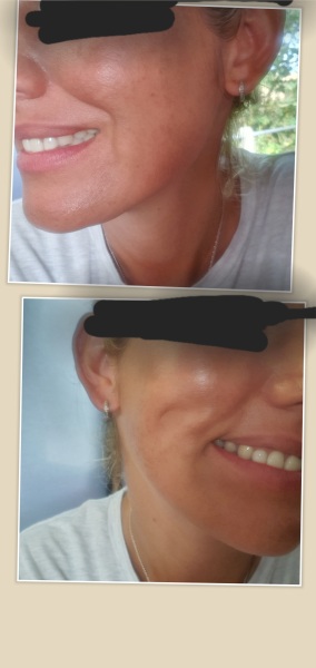 Dimple caused by cheek injury