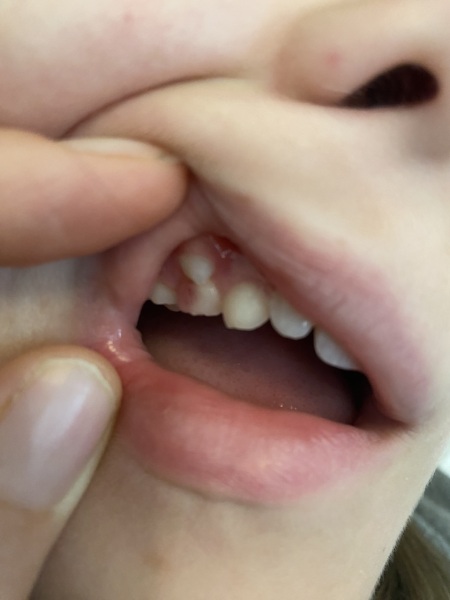 DD 10 has a pink tooth