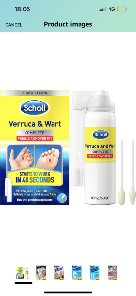 Does this look like I've got rid of the verruca's