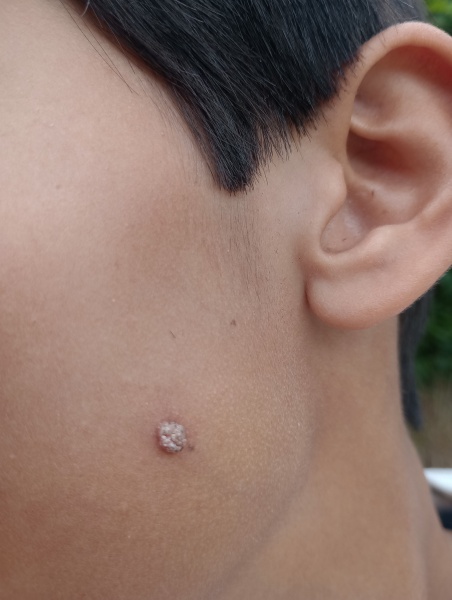 Panicking about DSs referral for skin mole