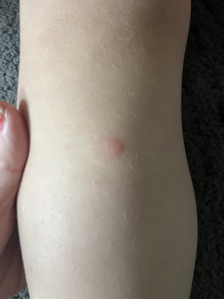 Mosquitoes?