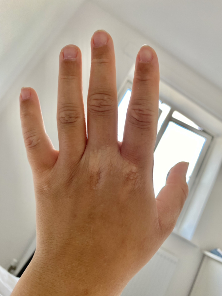 Would you say this it vitiligo or eczema?