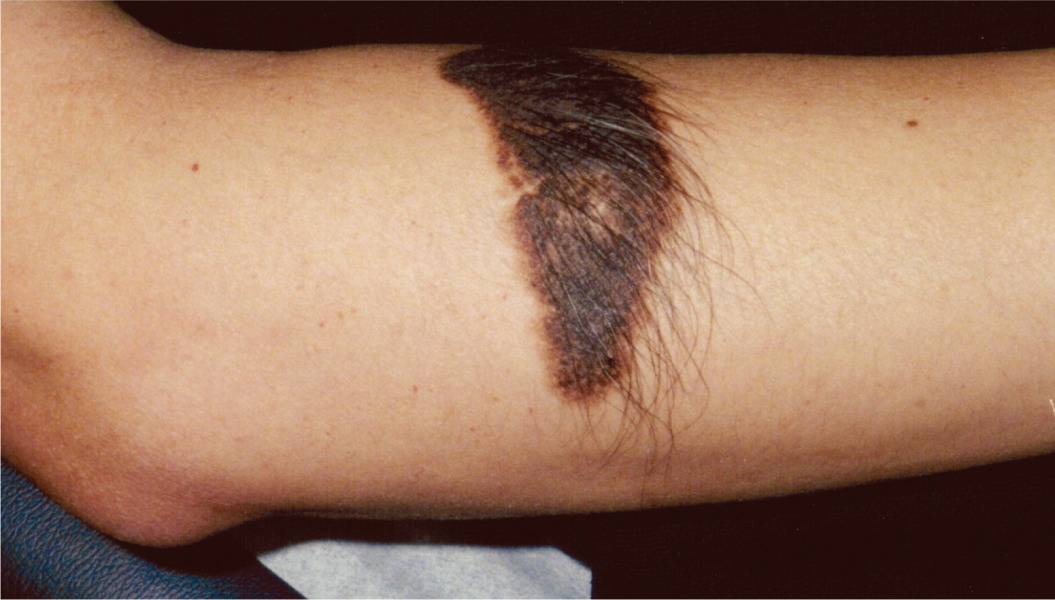 Noticed DD's birthmark for the first time today, DH worried it's going to be big