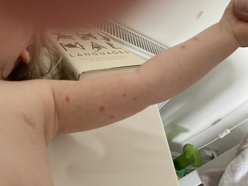 Could this be the start of chicken pox?