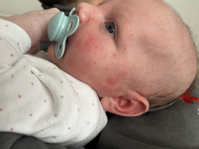 Cmpa or acne?