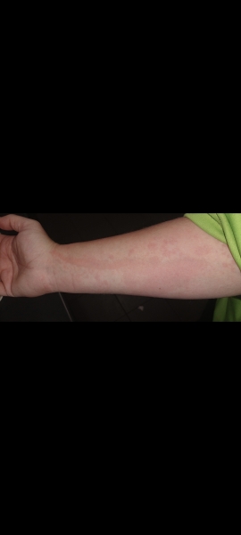 Chronic hives on boobs , PLS help .I’m miserable