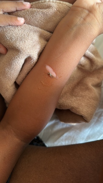 DS burn on arm on holiday