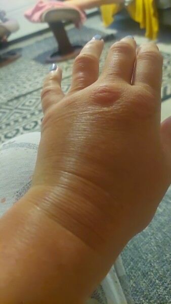 Who bit me?