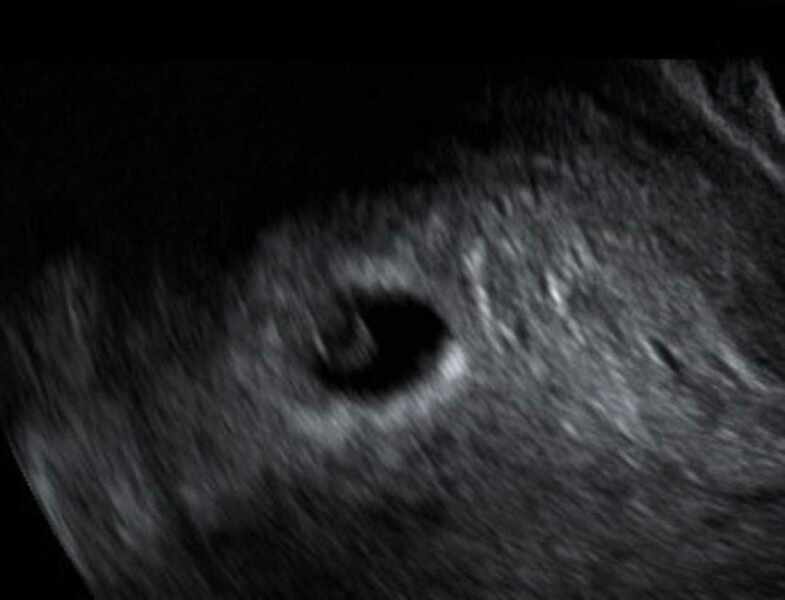 Lmp 8w4d, scan shows 5w3d (now 6w1d)