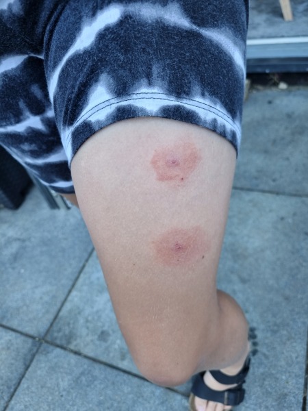Does this look like lymes disease?