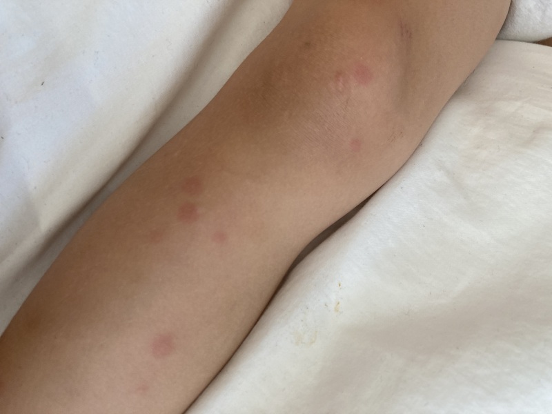 Spots/rash MMR reaction or chicken pox or something else?