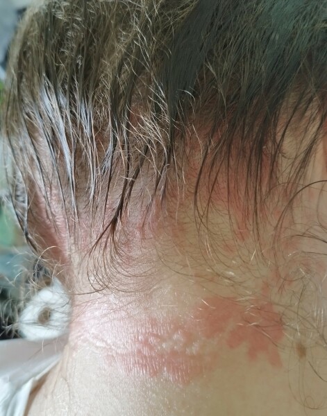 Does anyone know what this rash is?