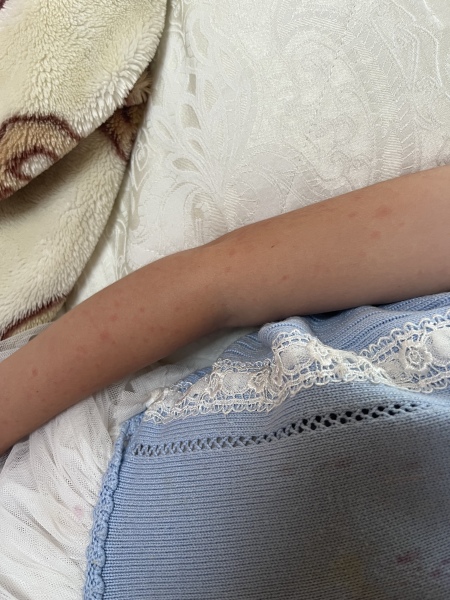 Rash , allergic reaction , Scarlett fever ????