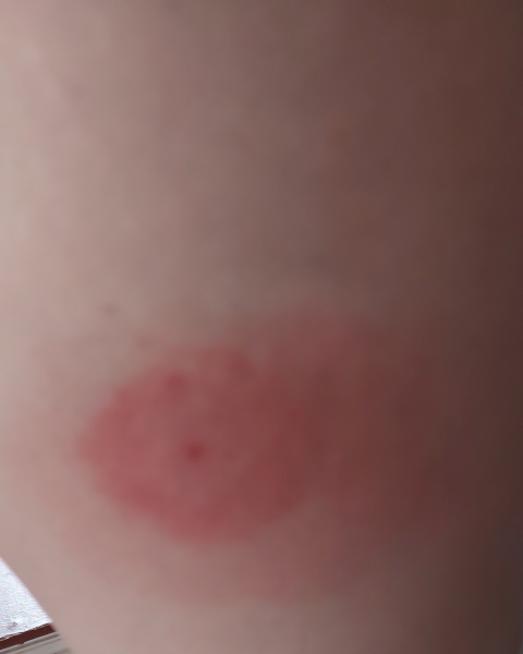 What is this rash 😧