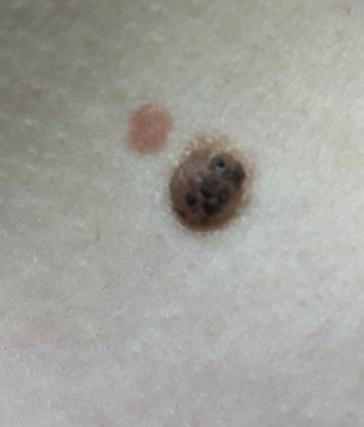 Worrying mole
