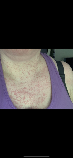 Chronic hives on boobs , PLS help .I’m miserable
