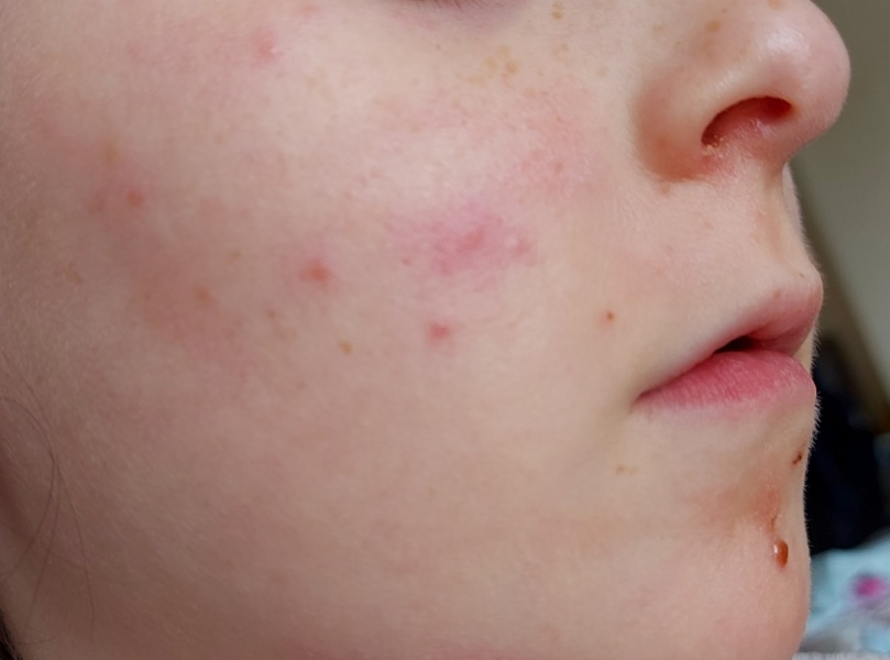 Spots on face and groin