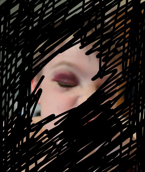To think this black eye was not an accident? Warning pic of black eye
