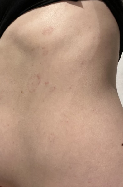 What is this rash on me?! Pics included