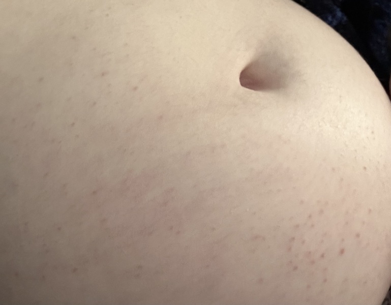 Stretchmarks