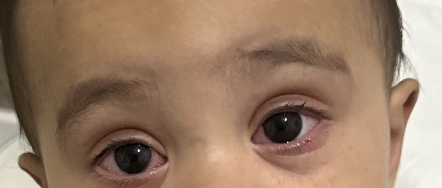 9 month old has eye infection that has caused a rash on his face?