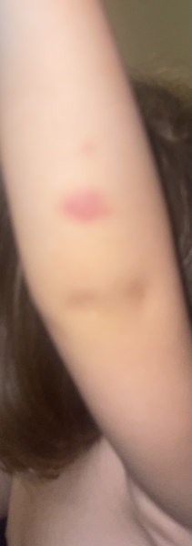 Toddler bruising