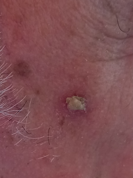 Skin cancer ? With image