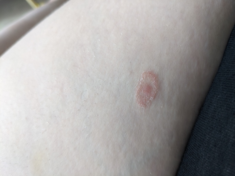 What is this rash?