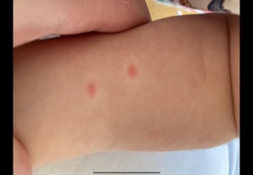 Could this be the start of chicken pox?