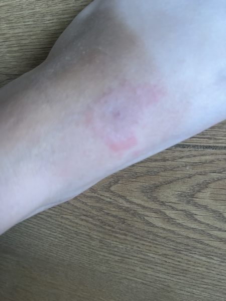 Insect bite, infected?