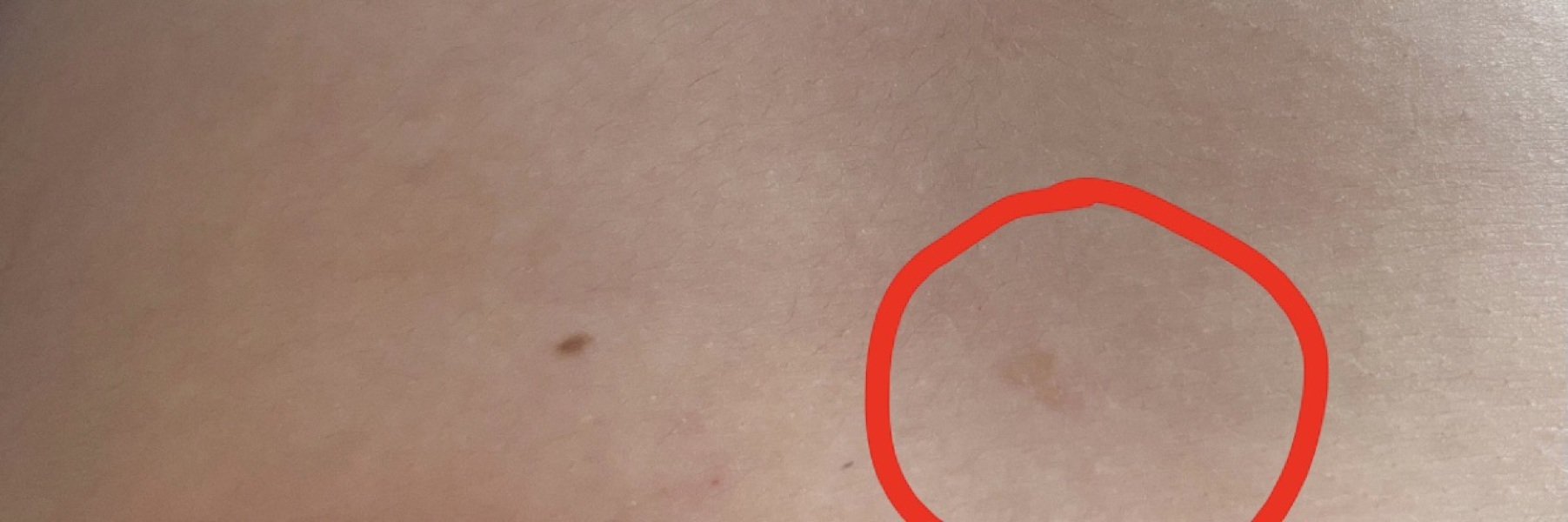 Is this melanoma